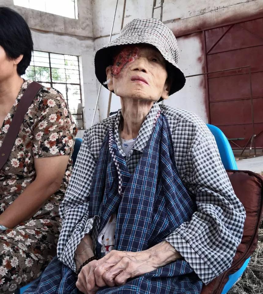 因果報應太可怕，一名80多歲的老太太臉上長嚴重的人面瘡